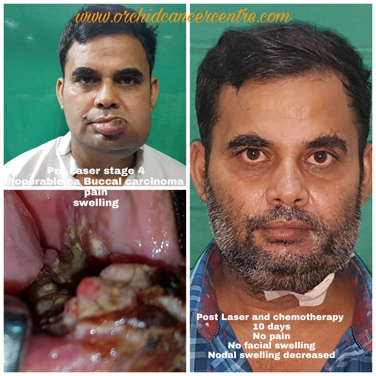 mouth cancer treatment in ayurveda, ayurvedic treatment for oral cancer, tongue cancer treatment in ayurveda